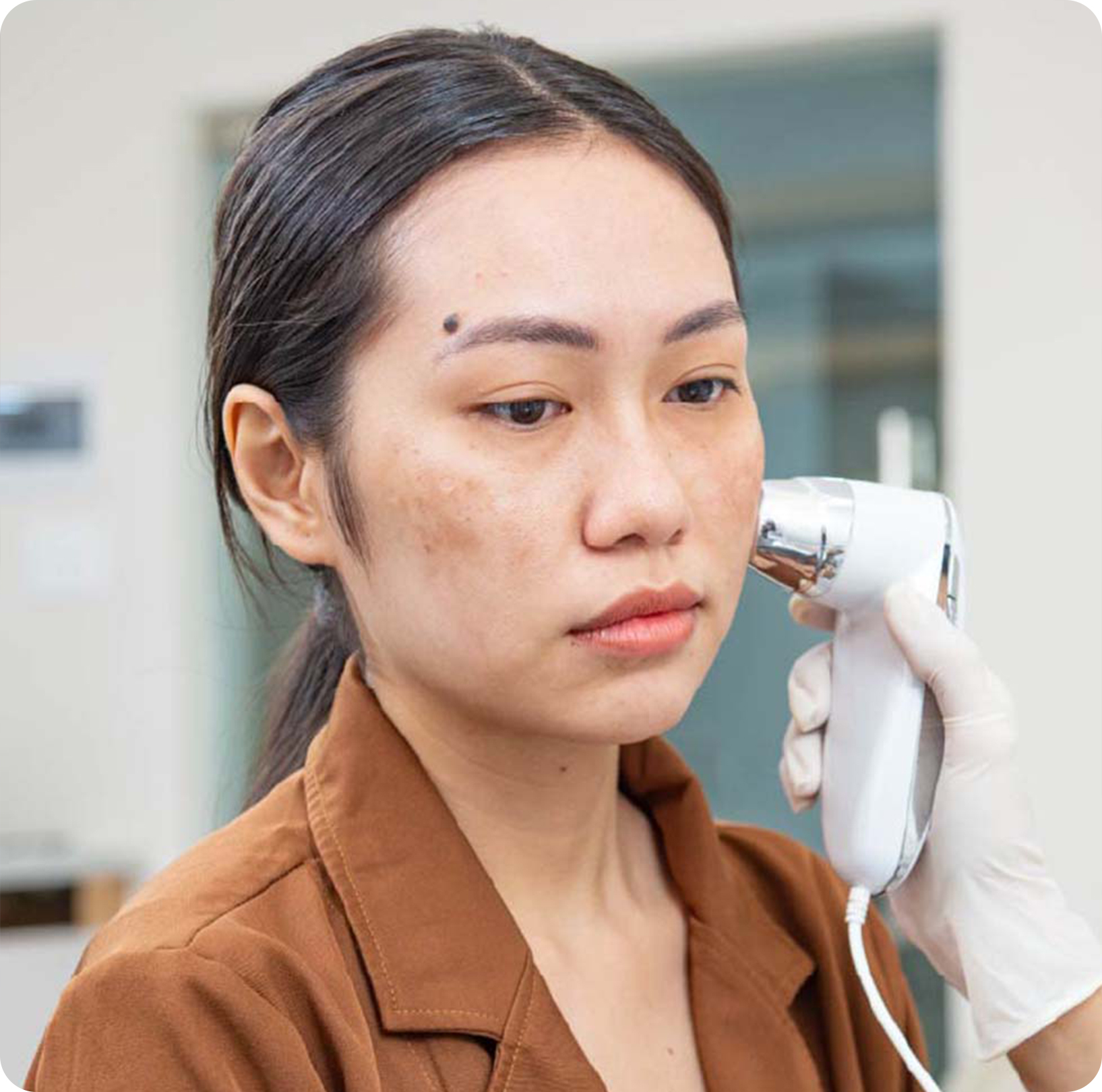 Da bị nám, tàn nhang, thâm sạm, hoặc những vấn đề khác do tăng sắc tố. Da bị nám, tàn nhang, thâm sạm, hoặc những vấn đề khác do tăng sắc tố.